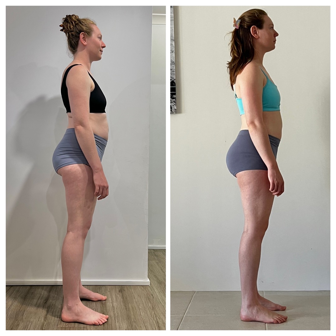 Before and after posture comparison, side view showing structural changes after treatment