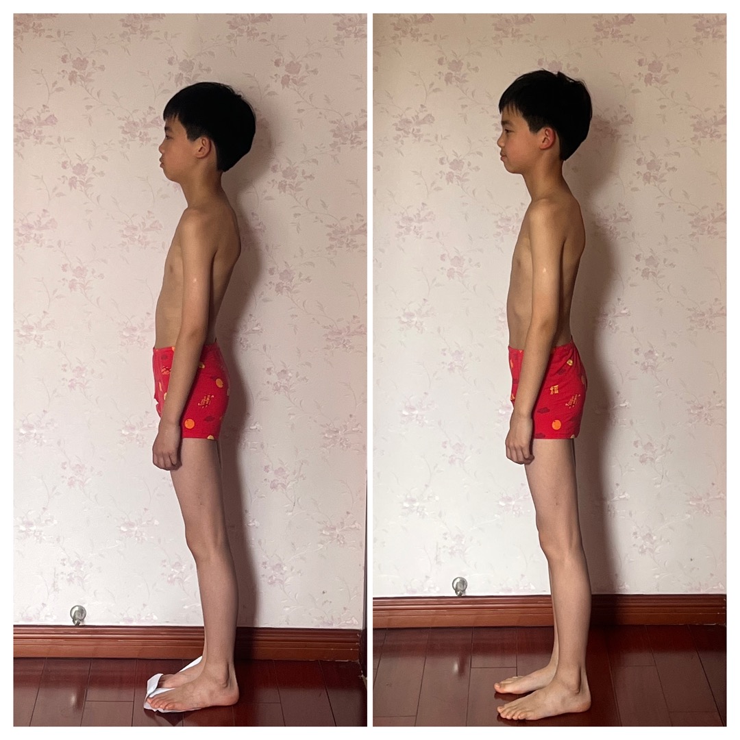 Before and after posture comparison, side view showing structural changes in an adolescent after Structural Integration treatment